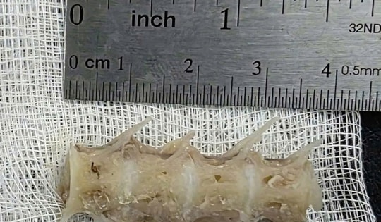 Xương cá kích thước 'khủng' găm chặt vào thực quản cụ ông 99 tuổi