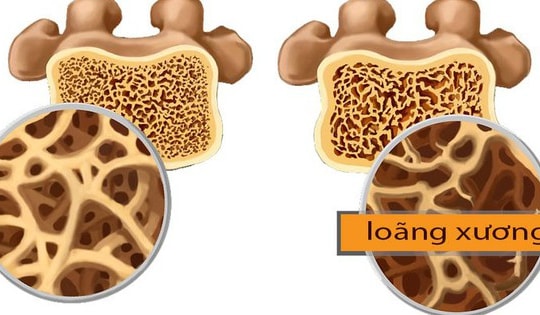 Loãng xương: Dự phòng và điều trị từ lối sống đến thuốc