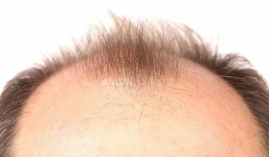 Đồ uống có đường - 'thủ phạm' gây rụng tóc ở nam giới