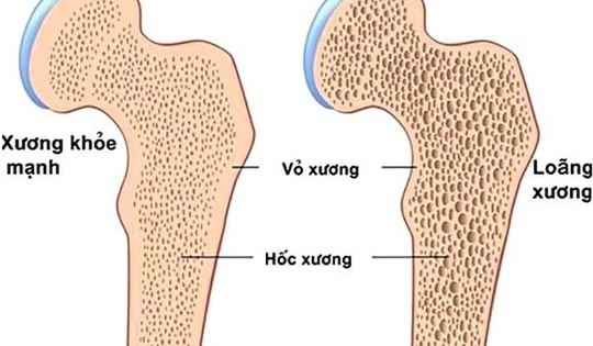 Loãng xương ở người cao tuổi dùng thuốc và chữa như thế nào?