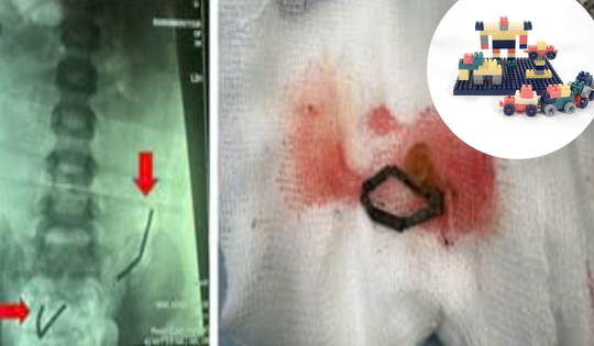 Nuốt 20 viên nam châm đồ chơi Lego, bé trai 5 tuổi thủng 8 lỗ ruột non