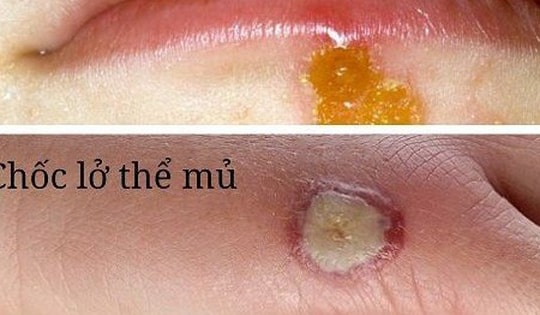 Bệnh chốc lở - Dùng thuốc nào để điều trị?