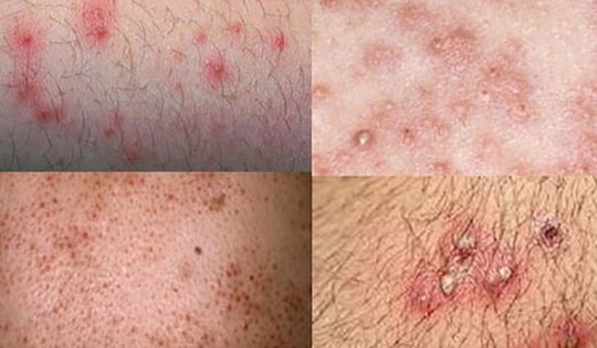 Điều trị viêm nang lông bằng thuốc - Khi nào cần sử dụng?