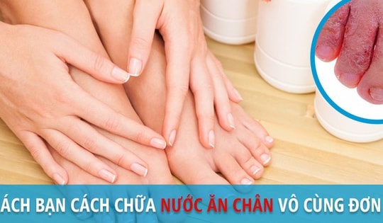 Nước ăn chân - Dùng thuốc và các phương pháp chữa trị tại nhà