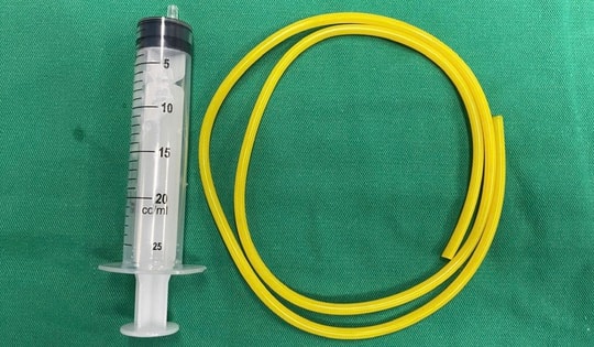 Nam thanh niên tự nhét ống cao su dài khoảng 1m vào bàng quang