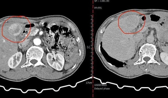Ung thư gan kèm nhiều bệnh nền, bệnh nhân hồi phục nhờ can thiệp nút mạch