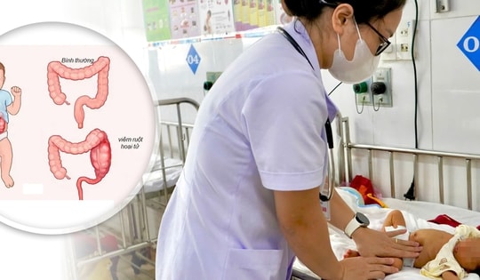 Cứu sống trẻ sinh non bị viêm ruột hoại tử
