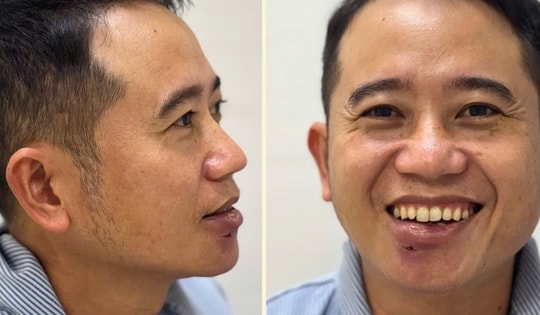 Tự điều trị mụn, nam bệnh nhân nhập viện vì áp xe sưng to vùng môi dưới