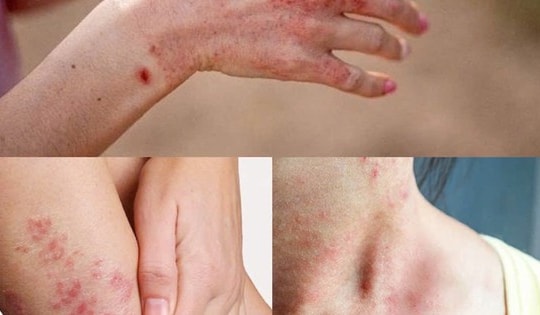 Thuốc điều trị viêm da trong mùa mưa