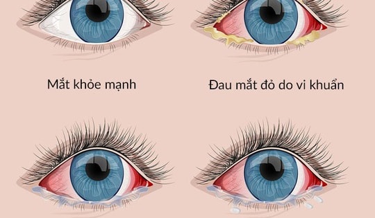 Đau mắt đỏ - Thuốc trị theo nguyên nhân và những biện pháp hỗ trợ không dùng thuốc