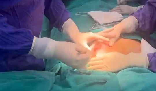 Sau tiêm nâng ngực 5 năm, nữ bệnh nhân bị biến chứng nặng