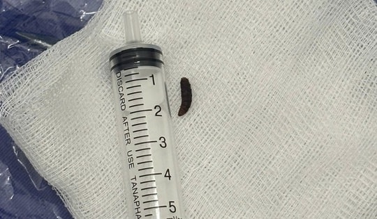 Phát hoảng trong tai bé 14 tháng tuổi có dòi còn sống