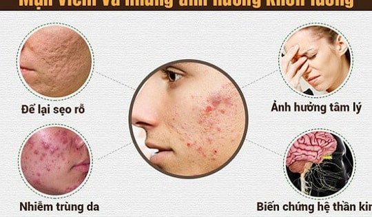 Dùng thuốc và cách chăm sóc da mụn viêm đỏ tại nhà