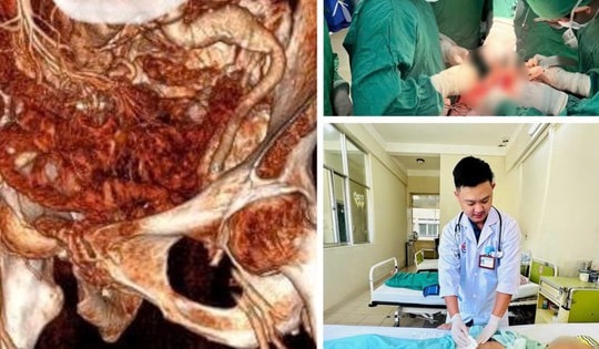 Phẫu thuật cứu sống kịp thời bệnh nhân 86 tuổi vỡ phình động mạch chủ bụng