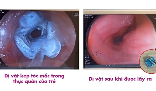 Cứu thành công bé 5 tuổi bị kẹt kẹp tóc trong thực quản