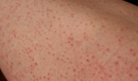 Điều trị viêm nang lông tại nhà bằng thuốc và các nguyên liệu tự nhiên