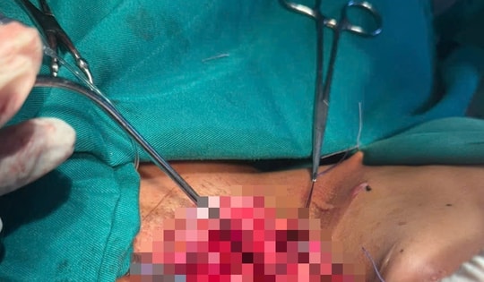 Cứu sống bệnh nhân bị dây điện sà giữa đường cứa đứt khí quản