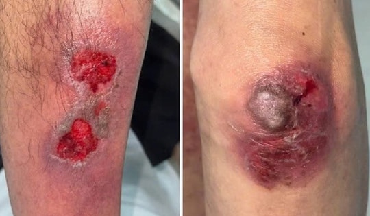 Uống sai liều thuốc da liễu, nhiều người ngộ độc nặng