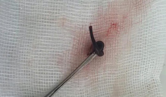 Phát hiện con vắt dài 3cm sống trong mũi cô gái hơn 1 tuần