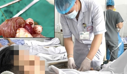 Một thanh niên bị xương cá đâm thủng ruột non, gây áp xe ổ bụng