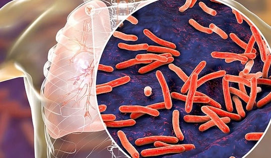 Dự phòng lao tiềm ẩn – 'lá chắn' quan trọng cho người đang điều trị ARV