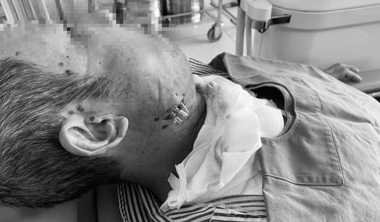 Suýt mất mạng vì tự ý đi đốt nhiệt khi đau răng