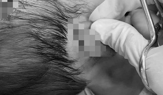 Bé gái 19 tháng tuổi bị chó dữ tấn công