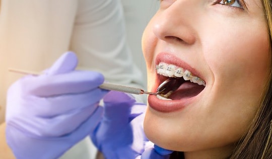 Nên ăn gì khi niềng răng để đảm bảo dinh dưỡng?