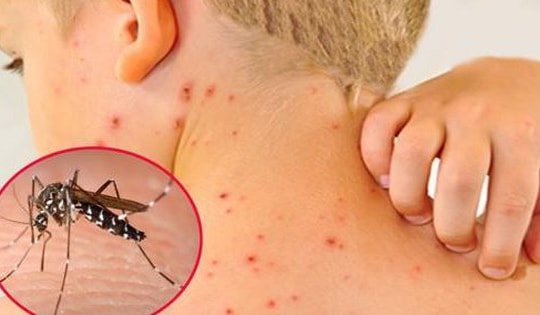 Đã có hơn 86.000 ca mắc sốt xuất huyết, bệnh ngày càng khó lường hơn do biến đổi khí hậu