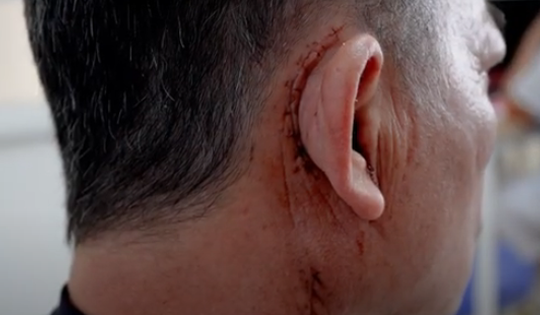 Loại bỏ khối u chung sống 10 năm gây liệt mặt