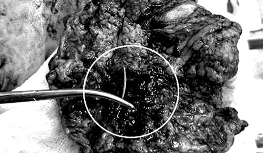 Cứu người bị áp xe ổ bụng hiếm gặp do mắc xương cá