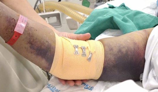 Nhiều người mắc sốt xuất huyết nguy kịch trong mùa mưa bão