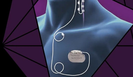 Lần đầu tiên tại Việt Nam thực hiện kỹ thuật điều biến dây thần kinh phế vị điều trị động kinh kháng thuốc