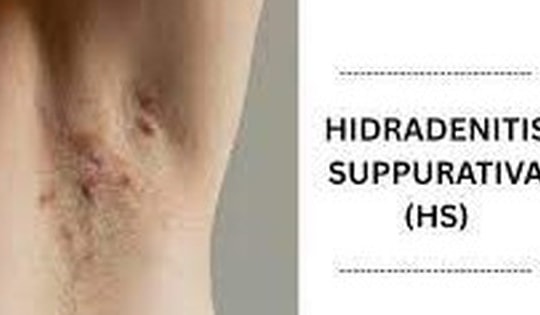 Thuốc trị viêm tuyến mồ hôi mủ