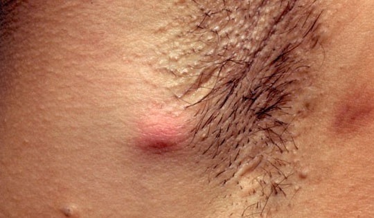 Thực phẩm bổ sung nào hỗ trợ điều trị viêm tuyến mồ hôi mủ?