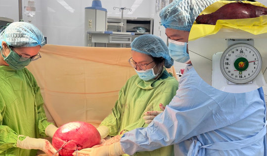 Cắt khối u xơ tử cung nặng 4,5kg, bụng nữ bệnh nhân to như thai 28 tuần