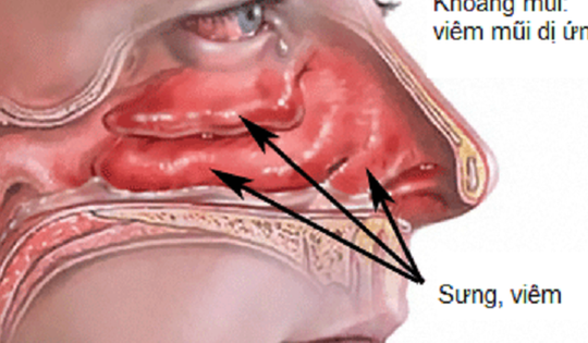Dùng thuốc trị viêm mũi dị ứng: Giảm nhanh triệu chứng, nhưng cần dùng đúng cách