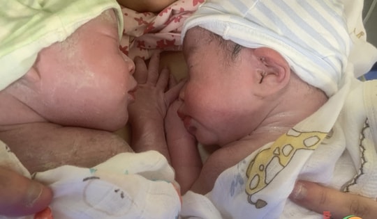 Ca song sinh chào đời hiếm gặp ở Quảng Ninh còn nguyên trong bọc ối