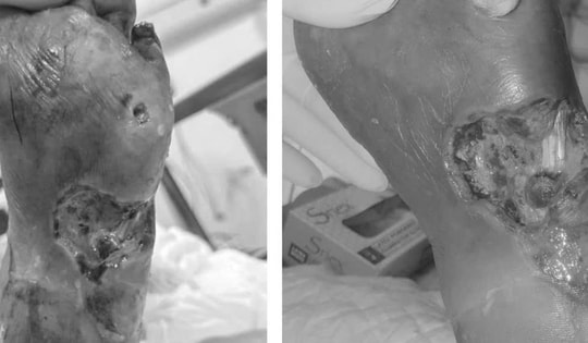 Người đàn ông suýt phải cắt cụt chân vì đái tháo đường