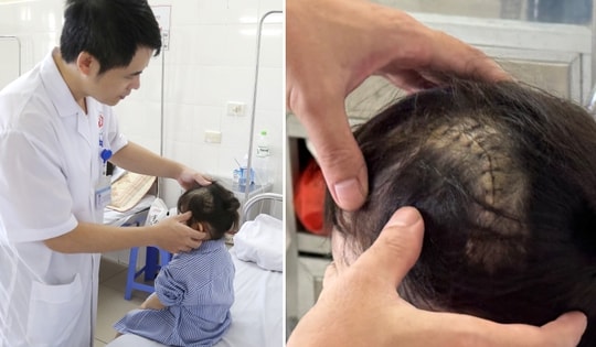 Ngã cầu thang trong lúc chơi, bé 3 tuổi bị vỡ xương sọ, tụ máu ngoài màng cứng