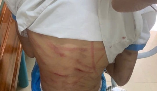 Xác minh thông tin bé gái nghi bị cha dượng bạo hành dã man