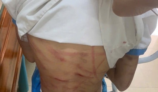 Công an triệu tập cha dượng nghi bạo hành bé gái