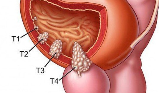 Thuốc phối hợp mới giúp giảm 40% nguy cơ tử vong do ung thư tuyến tiền liệt