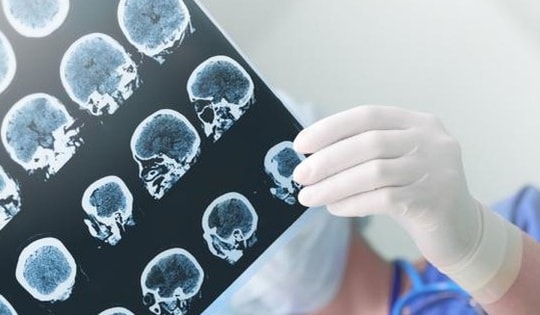 Người trẻ đối mặt với gánh nặng kép của đột quỵ não và sa sút trí tuệ