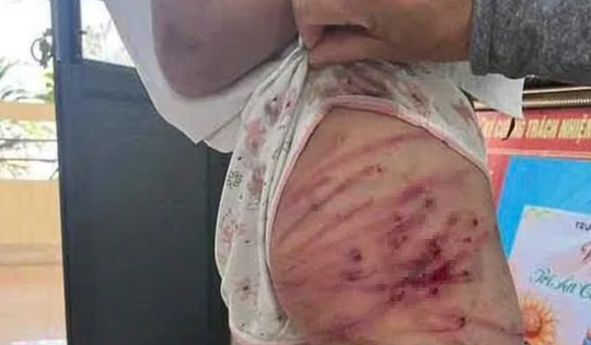 Bạo hành trẻ em: Vết thương từ gia đình và rào cản pháp lý