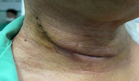 Phát hiện mắc cùng lúc 2 loại ung thư sau 6 tháng khàn tiếng