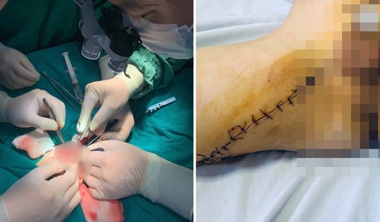 Nối dương vật thành công cho bệnh nhi ở Hải Phòng