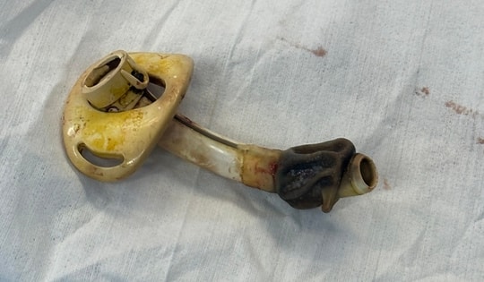 Người phụ nữ tìm lại hơi thở tự nhiên sau 7 năm sống cùng ống nội khí quản