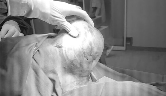 Khối u khổng lồ 1,5kg "mọc" trên vai người đàn ông 41 tuổi