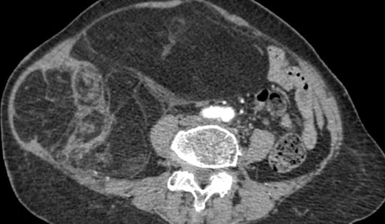 Bụng cụ bà to bất thường, căng tức, bác sĩ phẫu thuật lấy ra khối u ác tính gần 4kg